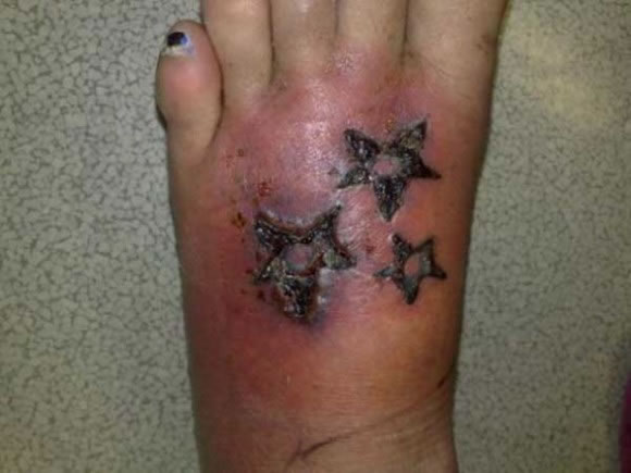 Infecciones de tatuajes y perforaciones (14)