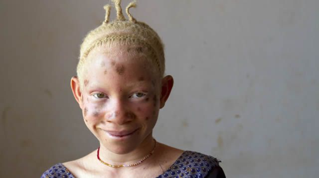 Persecución Caza Albinos Tanzania (13)