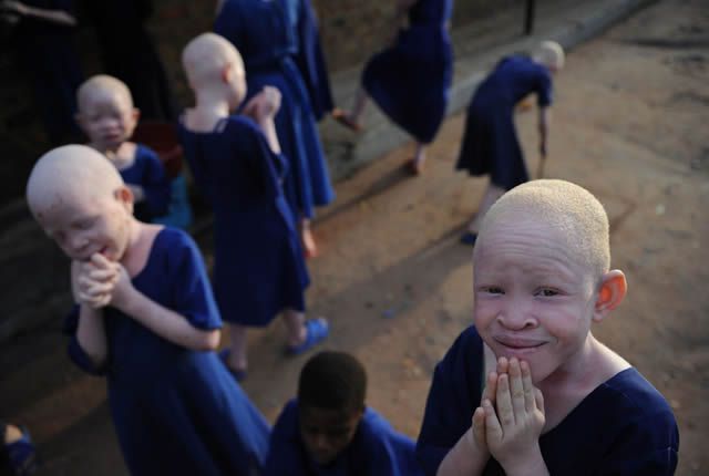 Persecución Caza Albinos Tanzania (4)