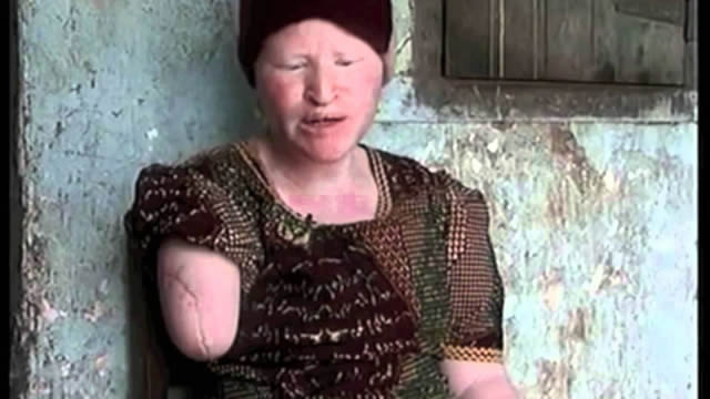 Persecución Caza Albinos Tanzania (3)