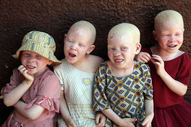Persecución Caza Albinos Tanzania (2)