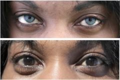 implante iris artificial, cambiar color de ojos (7)
