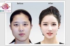 Cirugía Plástica en Corea Antes y Despues 2 (31)