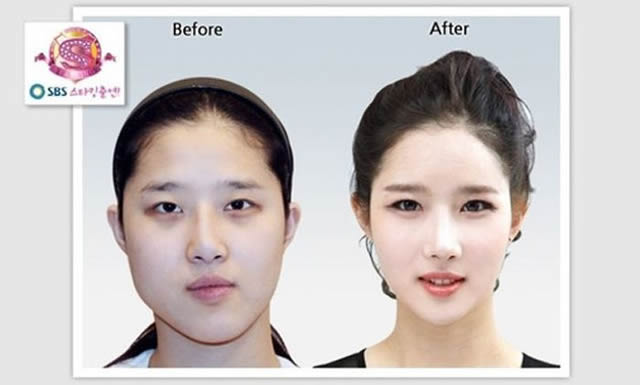 Cirugía Plástica en Corea Antes y Despues 2 (31)