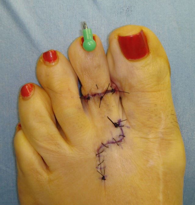 Cirugía Cenicienta pies (2)
