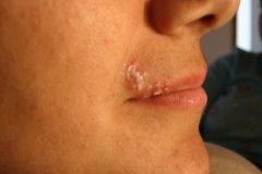 6 enfermedades transmitidas por la saliva