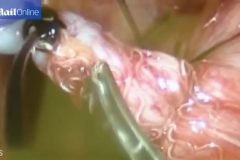 Médicos encuentran infestación de gusanos durante cirugía por apendicitis