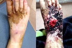 A esta adolescente le amputan la pierna a causa de una uña encarnada