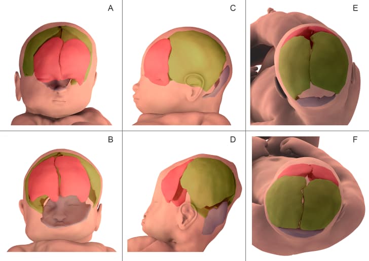 fontanelas y forma del cerebro en bebes