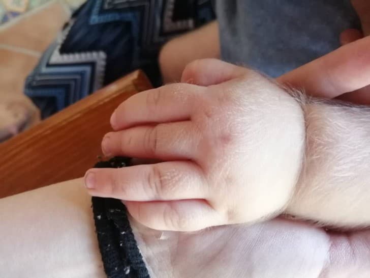 mano de un bebe con hipertricosis