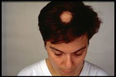 alopecia areata(1)