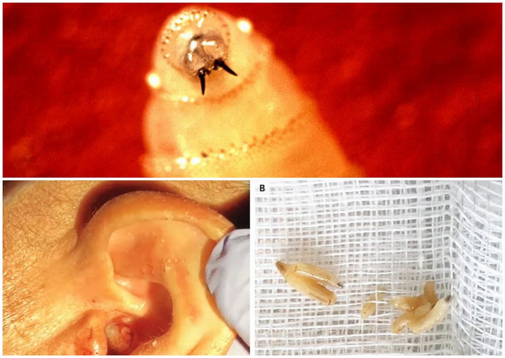 infección de oído y encontraron larvas carnívoras(1)
