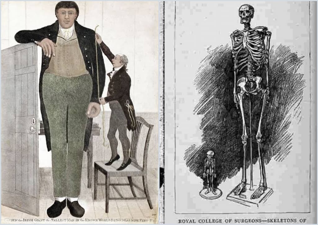 esqueleto de Charles Byrne el gigante irlandes