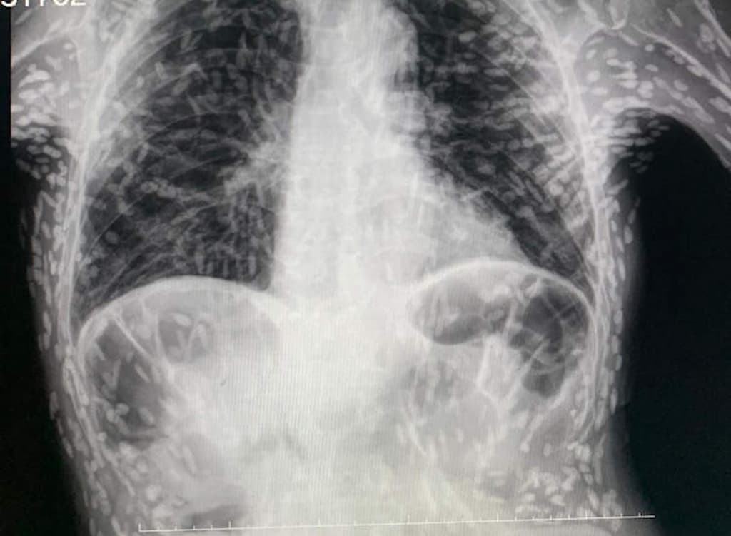 radiografía de un hombre lleno de cisticercos