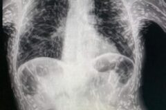 radiografía de un hombre lleno de cisticercos(1)